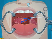 Play Operate Now: Tonsil Surgery
